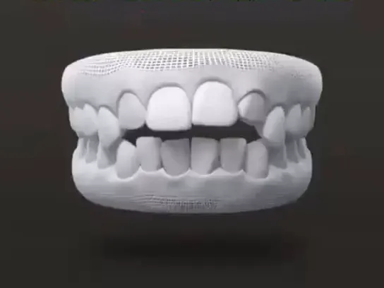 Escaneamento 3D de arcada dentária 3